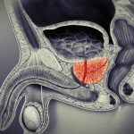 3D Treatment for Prostatitis Review
